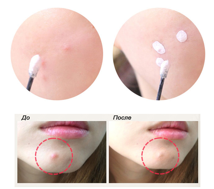 Средство от акне ciracle pimple solution pink powder